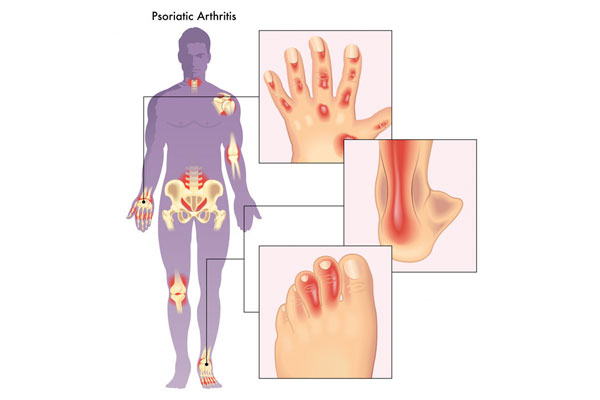 Artrite Psoriasica