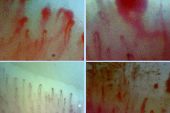 La videocapillaroscopia